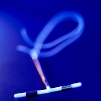 méhtestrák, méhen belüli fogamzásgátló méhtestrák, méhen belüli fogamzásgátló
