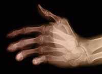 rheumatoid arthritis rheumatoid arthritis