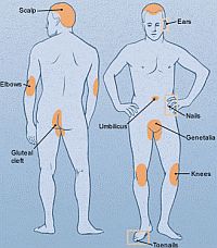 pikkelysömör psoriasis