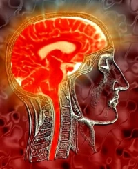 sclerosis multiplex sclerosis multiplex