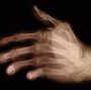 reumatoid arthritis reumatoid arthritis