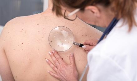 Anyajegyszűrés anyajegy melanoma
