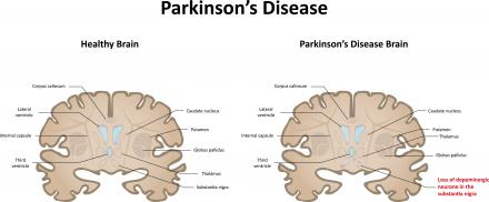 Parkinson-kór