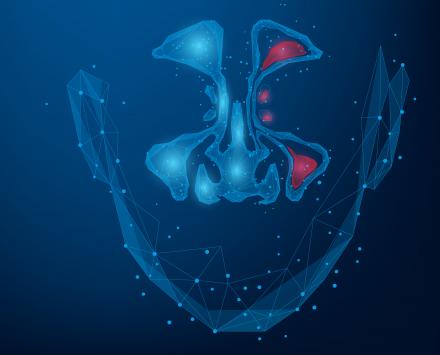 Sinusitis