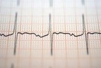 EKG-vizsgálat, szívbetegség