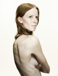 anorexia nervosa anorexia nervosa