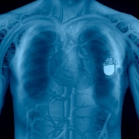 pacemaker pacemaker