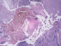 bőrrák, melanoma, daganat bőrrák, melanoma, daganat