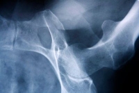csont, fibrodysplasia csont, fibrodysplasia
