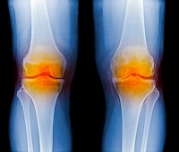 térd osteoporosis kezelés áttekintése