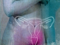 endometriózis endometriózis