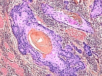 melanoma, immunrendszer