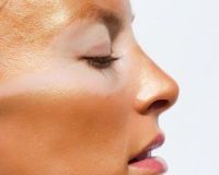 rosacea, napégés rosacea, napégés