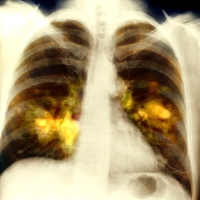 röntgen, tüdőrák