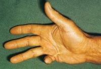ínzsugor Dupuytren contractura ínzsugor Dupuytren contractura