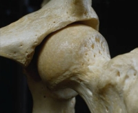 csontritkulás, oszteoporózis