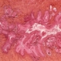 méhnyakrák, HPV-írus
