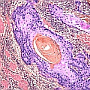 melanoma, immunrendszer