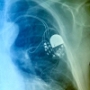 pacemaker pacemaker