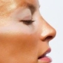 rosacea, napégés