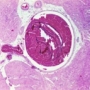 trombózis, mélyvénás, visszér, visszeresség, lábszárfekély trombózis, mélyvénás, visszér, visszeresség, lábszárfekély